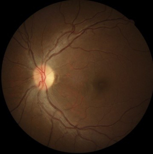 Linezolid induced optic neuropathy, a serious yet reversible adverse effect: a case report